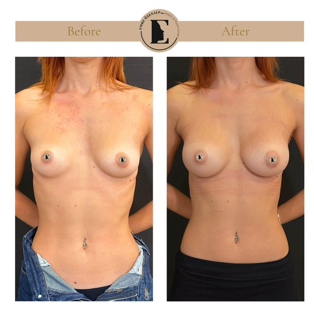 MIA Femtech before after result 1 Cup up