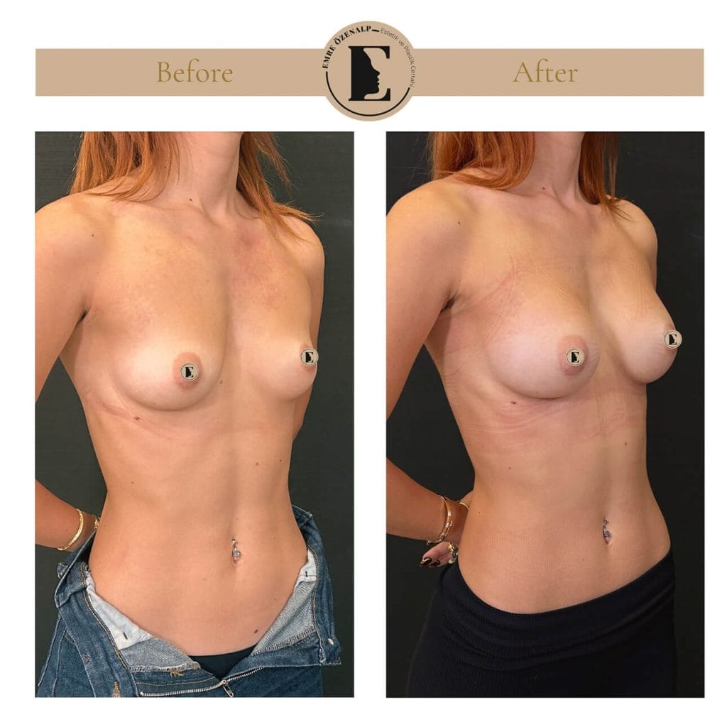 MIA Femtech before after result 1 Cup up