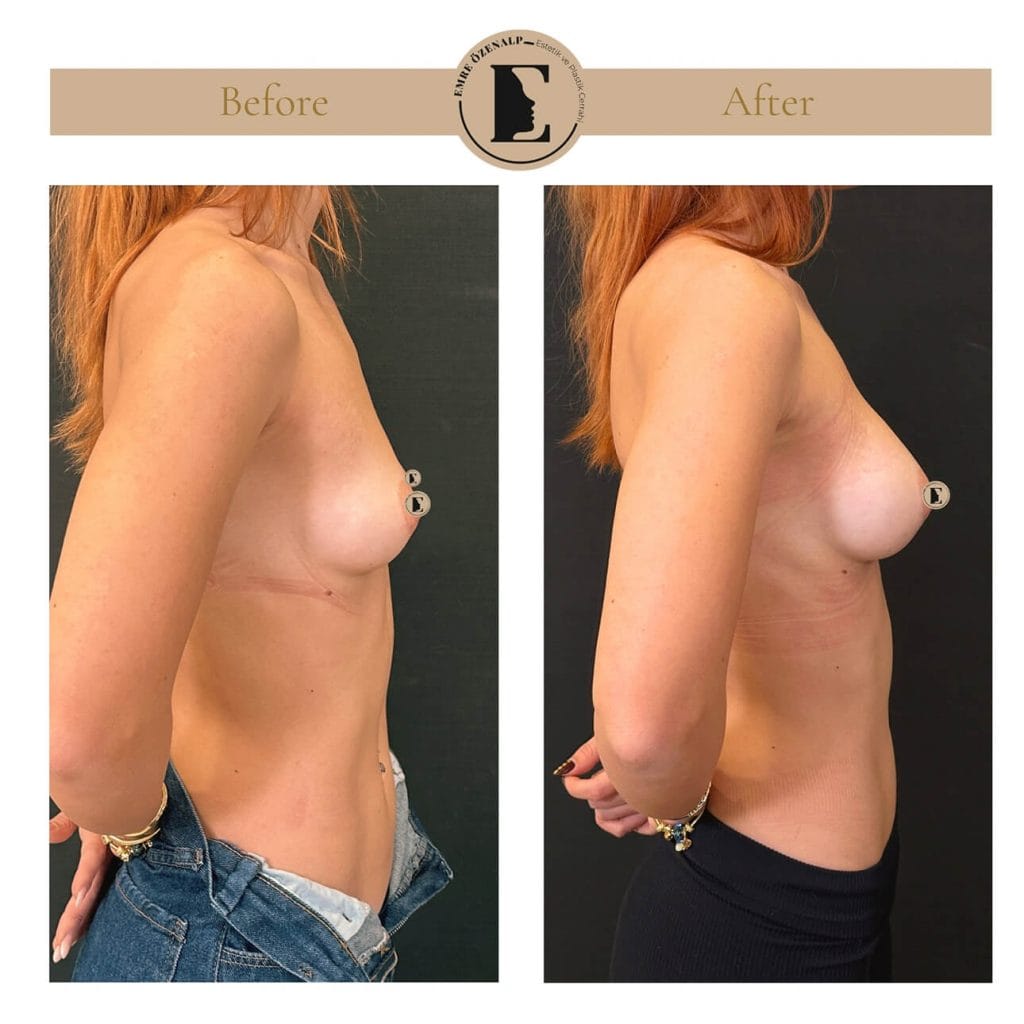 MIA Femtech before after result 1 Cup up
