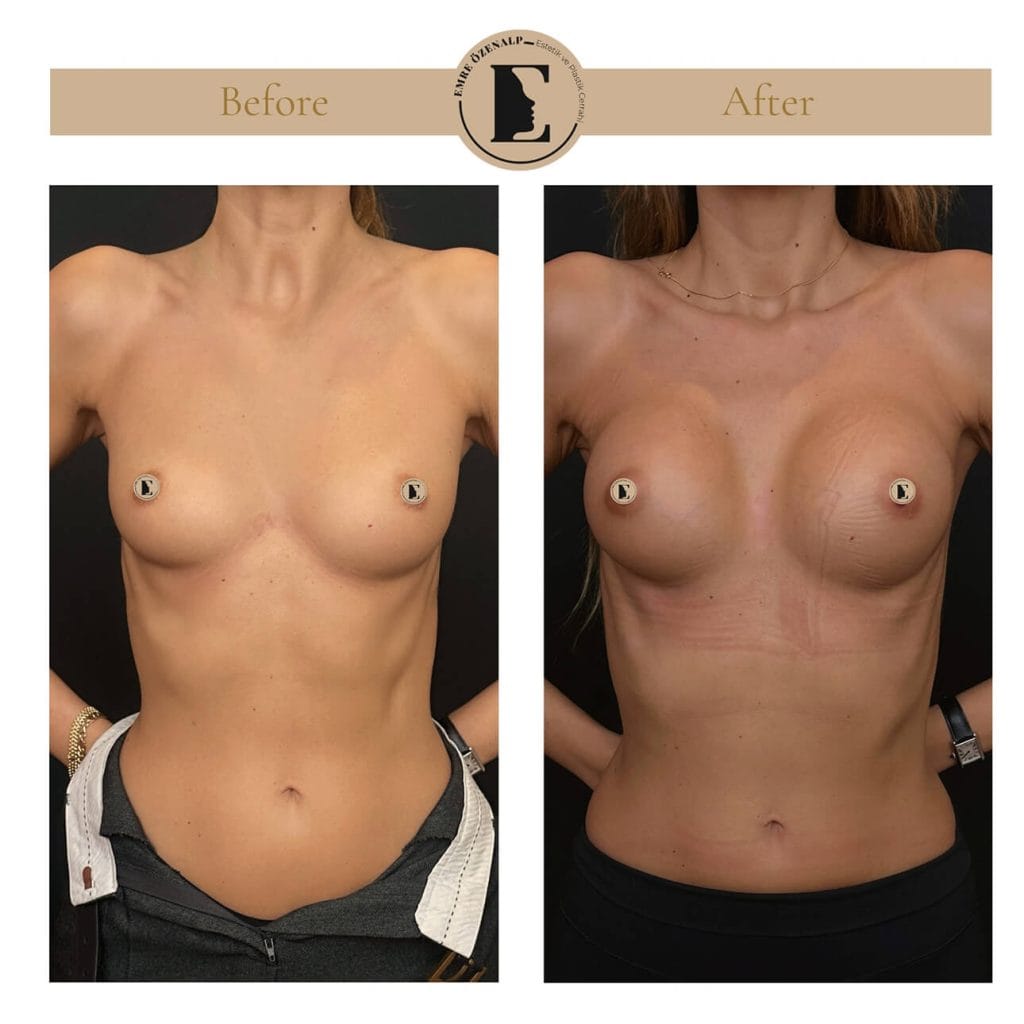 MIA Femtech before after result 1 Cup up