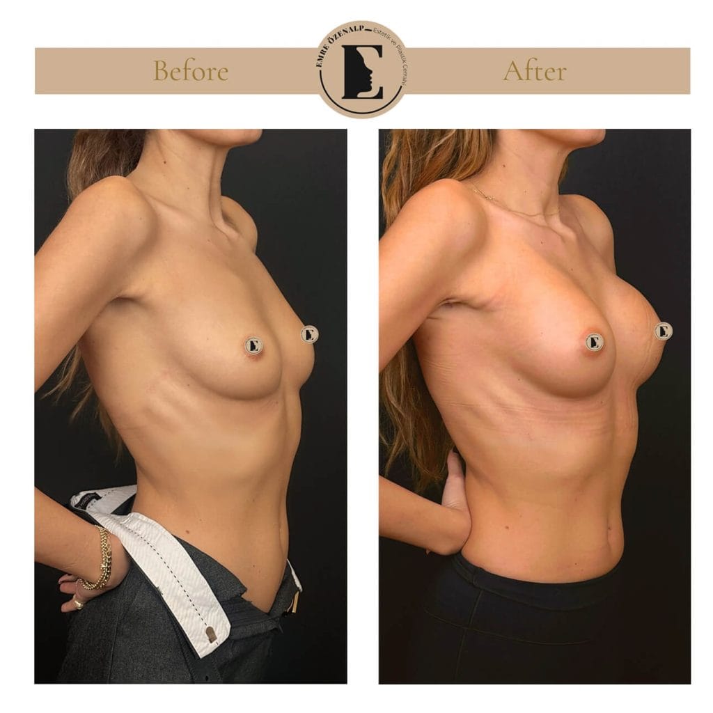 MIA Femtech before after result 1 Cup up