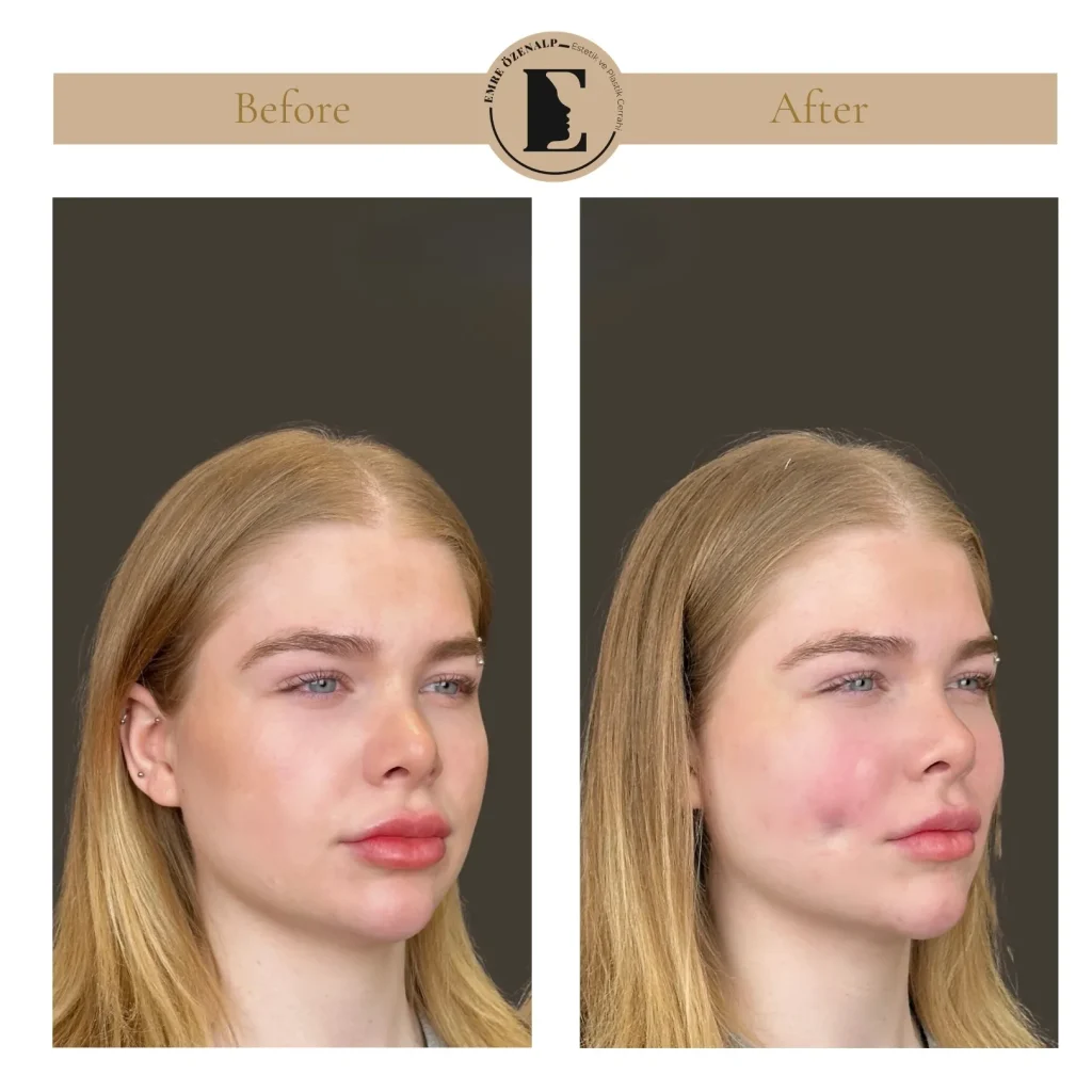 Dimple creation surgery (dimplasty) before after in Turkey results with experienced doctor Emre Özenalp.