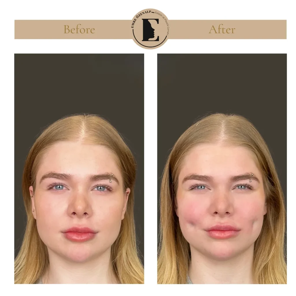 Dimple creation surgery (dimplasty) before after in Turkey results with experienced doctor Emre Özenalp.