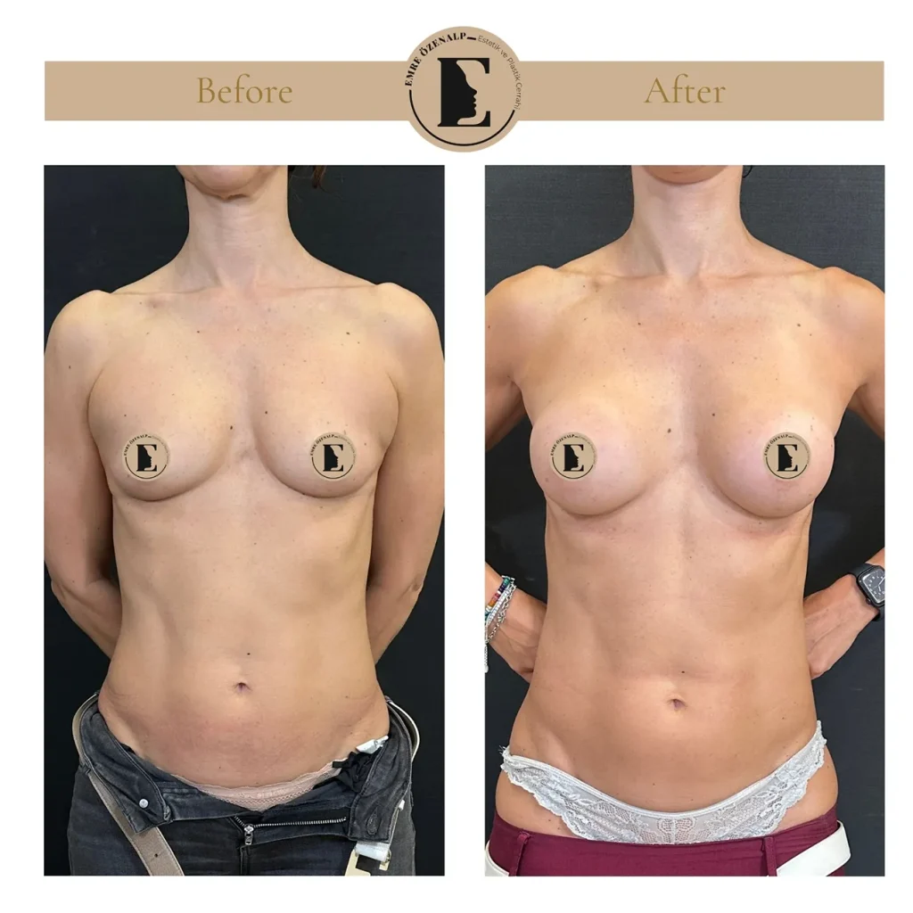 MIA Femtech before after result 1 Cup up