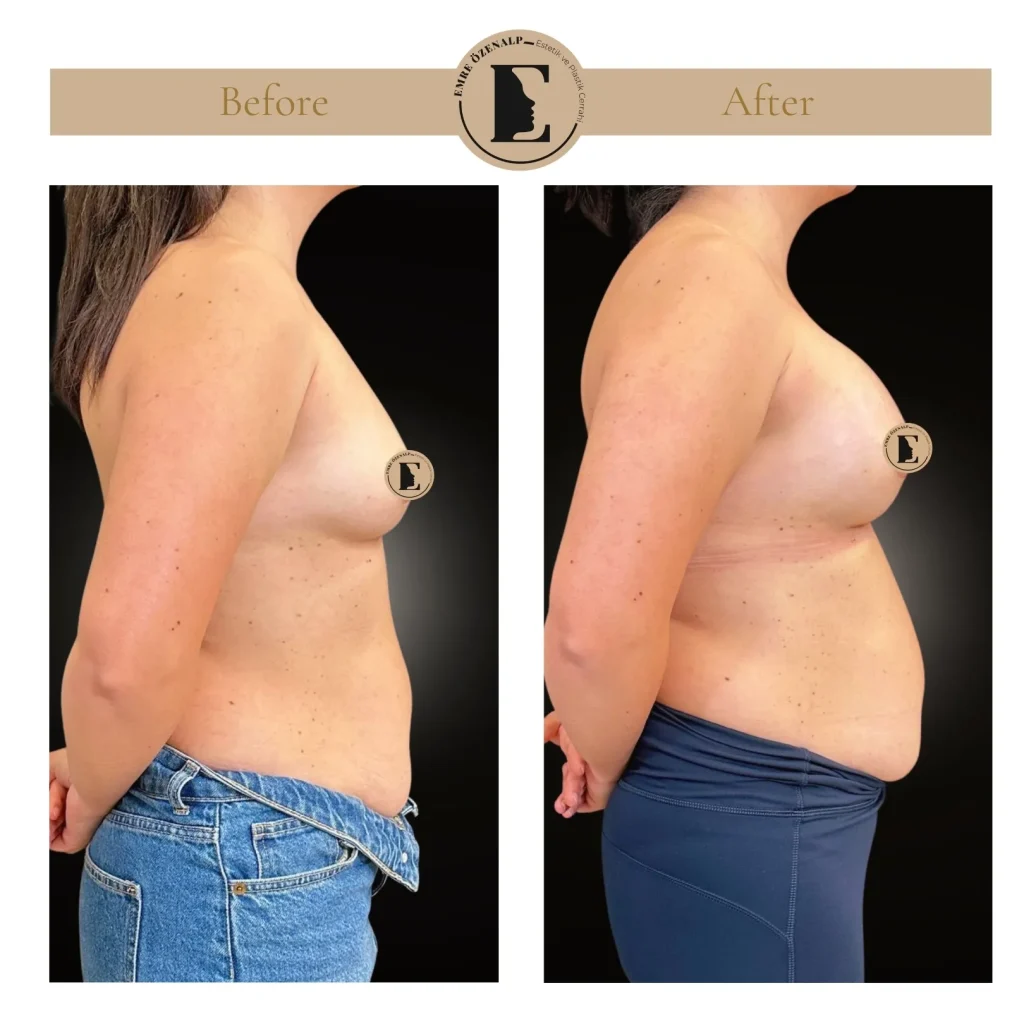 Motiva Preserve breast augmentation with Ergonomix2 320cc implant
