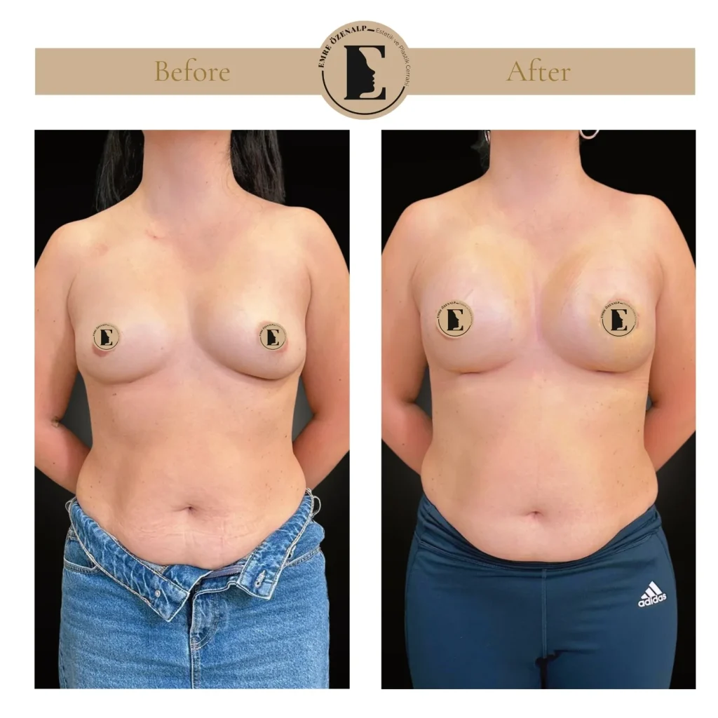 Motiva Preserve breast augmentation with Ergonomix2 320cc implant
