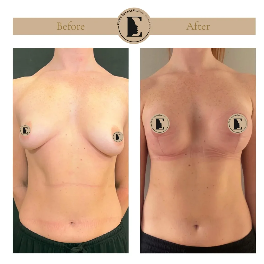 Motiva Preserve breast augmentation with Ergonomix2 300cc implant