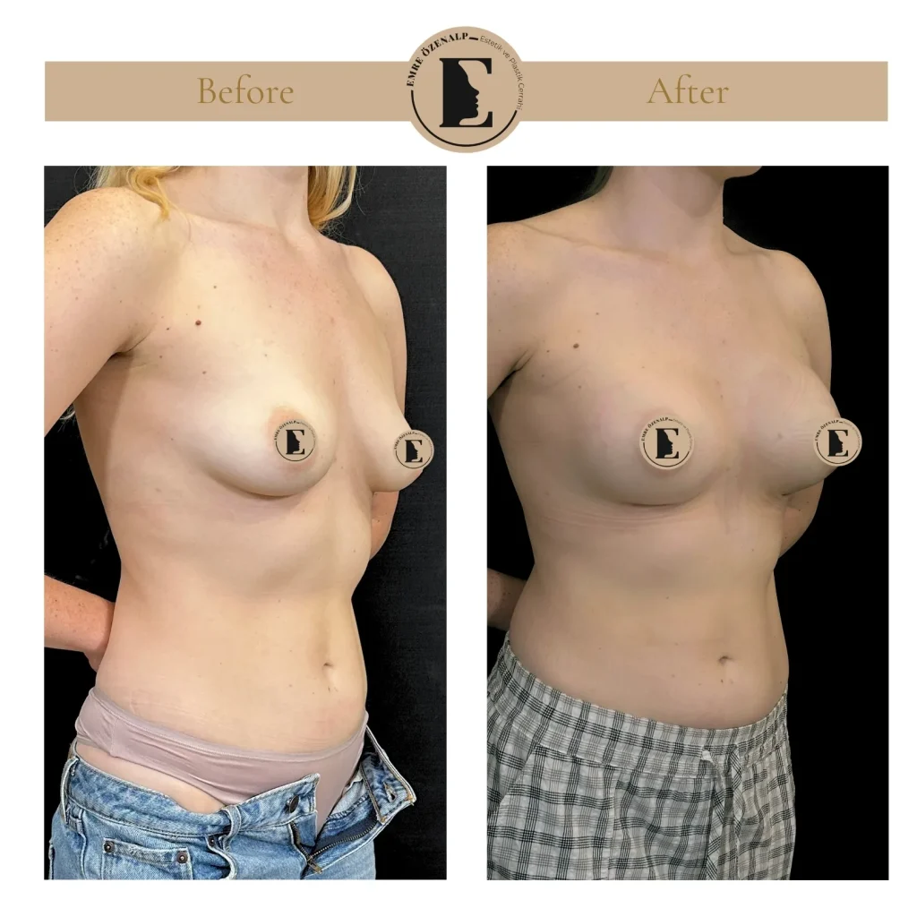 Motiva Preserve breast augmentation with Ergonomix2 320cc implant