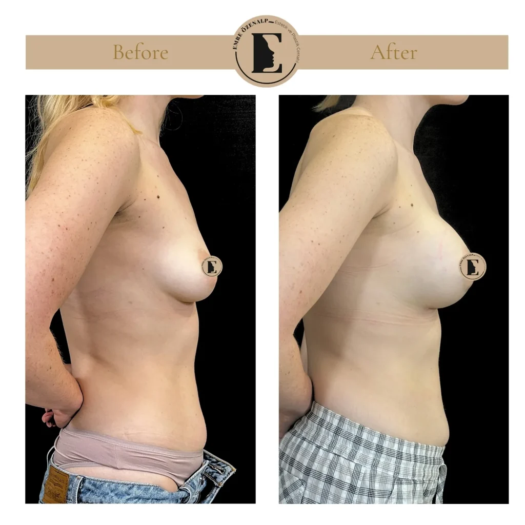 Motiva Preserve breast augmentation with Ergonomix2 320cc implant
