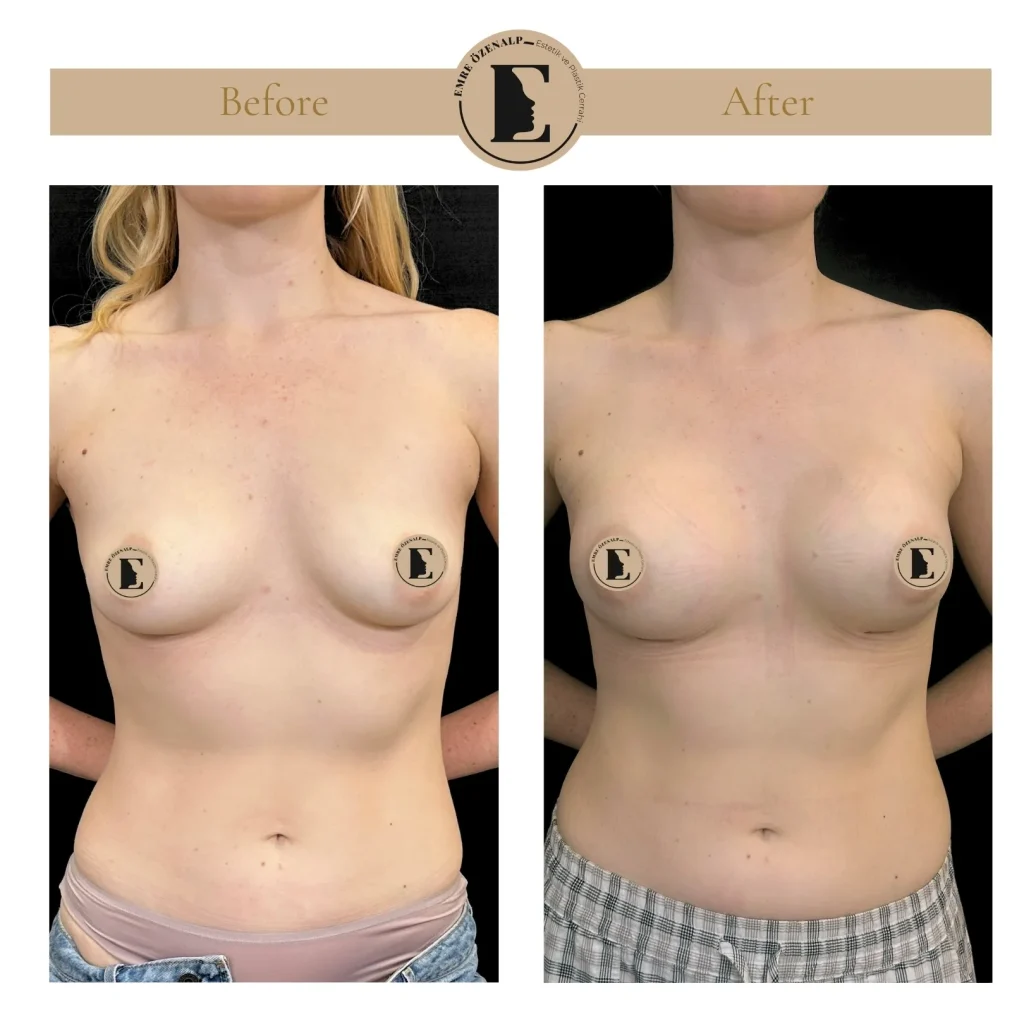 Motiva Preserve breast augmentation with Ergonomix2 320cc implant